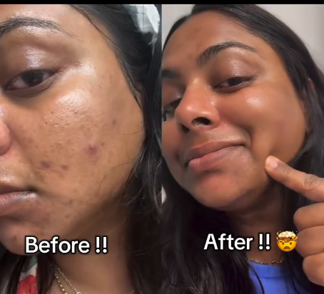 7-day acne healing journey with Purito Panthenol Cream